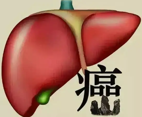 健康热点：日确诊肝癌患者达千人，原发性肝癌到底“偏向”哪些人?