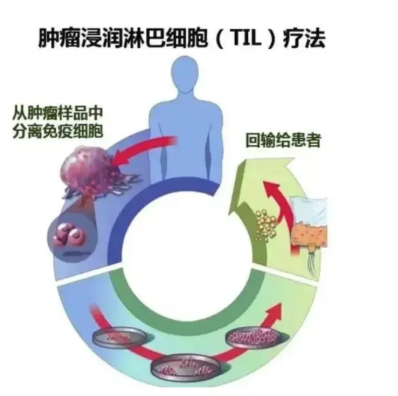 【临床试验热点】TILs疗法治疗肺癌、黑色素瘤、宫颈癌等肿瘤——利用自身免疫细胞杀死癌细胞