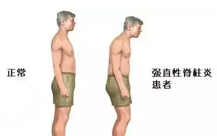 【强直性脊柱炎】这种”不死的癌症“现已获救——司库奇尤单抗(可善挺)已入医保