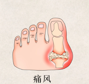 被痛风性关节炎折磨的日子成为过去式【痛风临床试验免费用药招募患者】