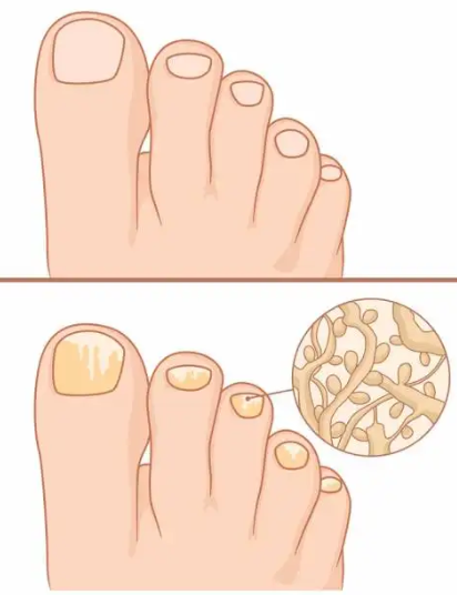 灰指甲有哪些表现?该怎么治?【灰指甲患者招募】
