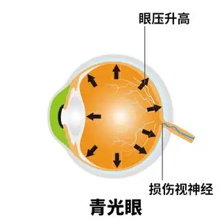 【青光眼科普】这个杀手有点狠，悄悄夺走老年人视力-青光眼新药NCX470