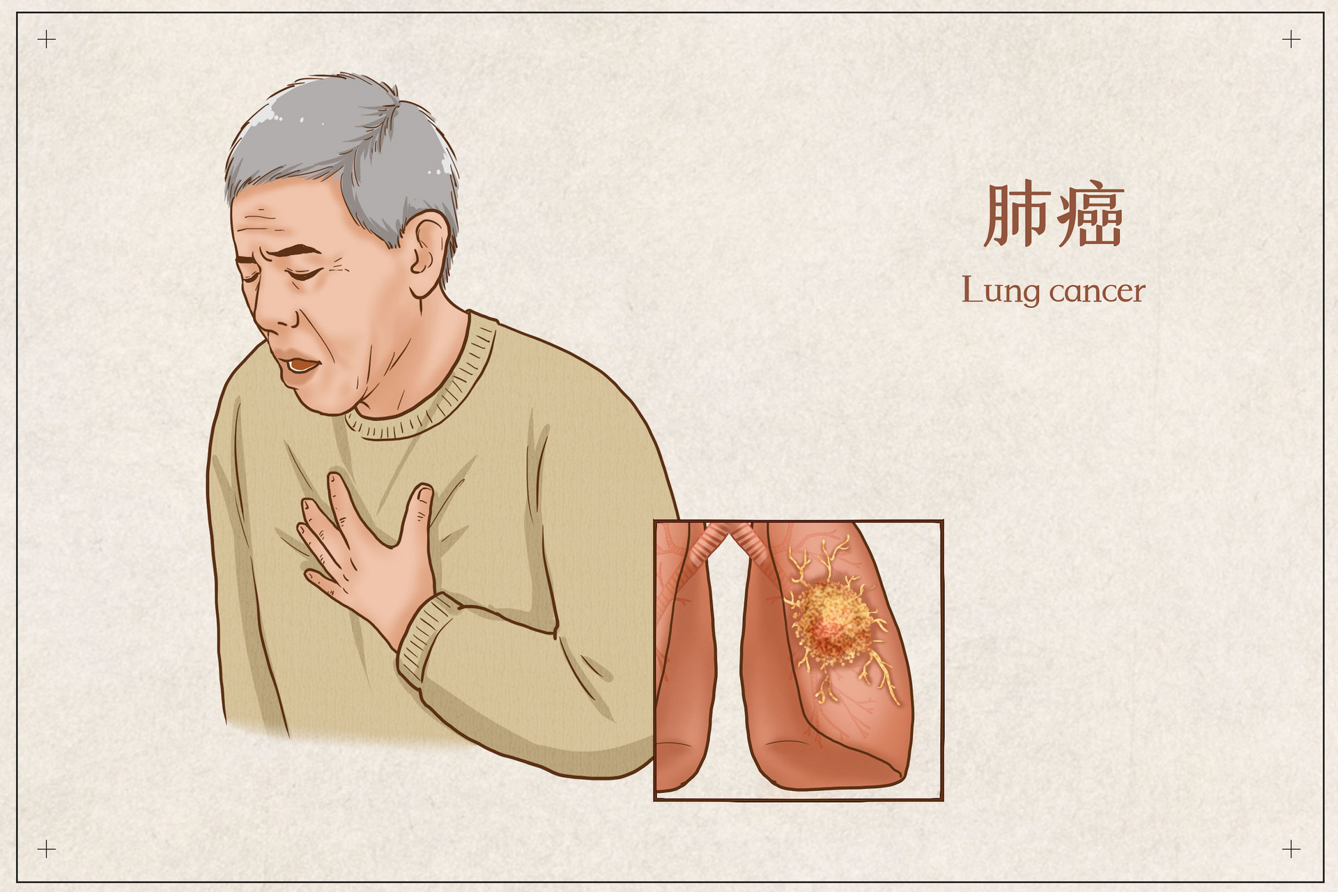 喜报!小细胞肺癌二线治疗迎来突破(小细胞肺癌治疗)