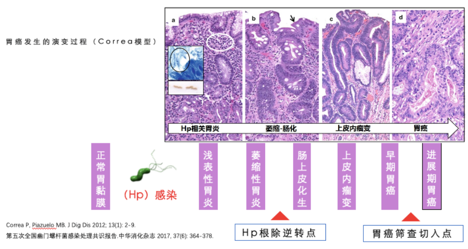 <a href=https://www.linchuangsy.com/Recruit/73/0.html title='胃癌' style='color: #1ca9b6;'>胃癌</a>的演变过程