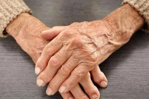 类风湿关节炎的治疗方法有哪些选择?如何选择适合自己的治疗方式?