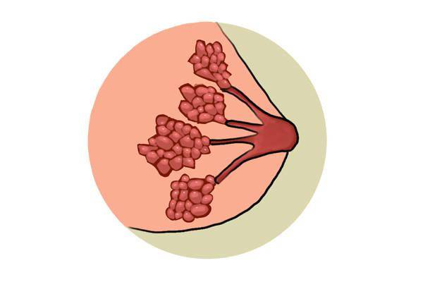 三阴乳腺癌是不是很严重?三阴乳腺癌是什么导致的?